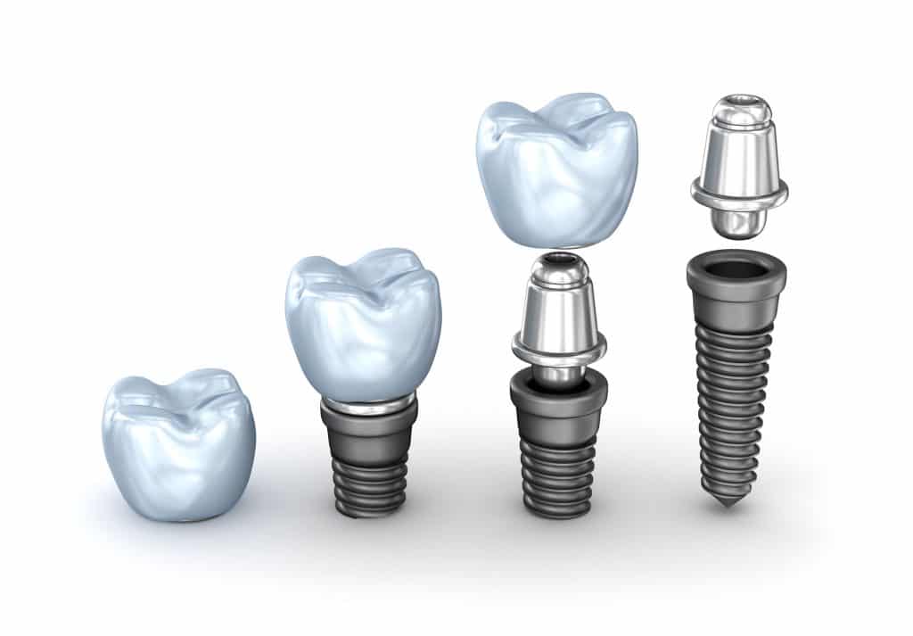 Implant dentaire la Défense  Tiers payant  Centre ADN
